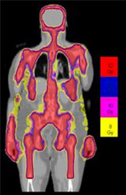 Role of radiotherapy in treatment of extramedullary relapse following total marrow and lymphoid irradiation in high-risk and/or relapsed/refractory acute leukemia